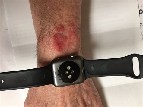 apple watch rash.